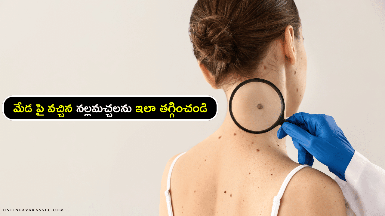 Black Spots on Neck Removal - మేడ పై వచ్చిన నల్లమచ్చలను ఇలా తగ్గించండి