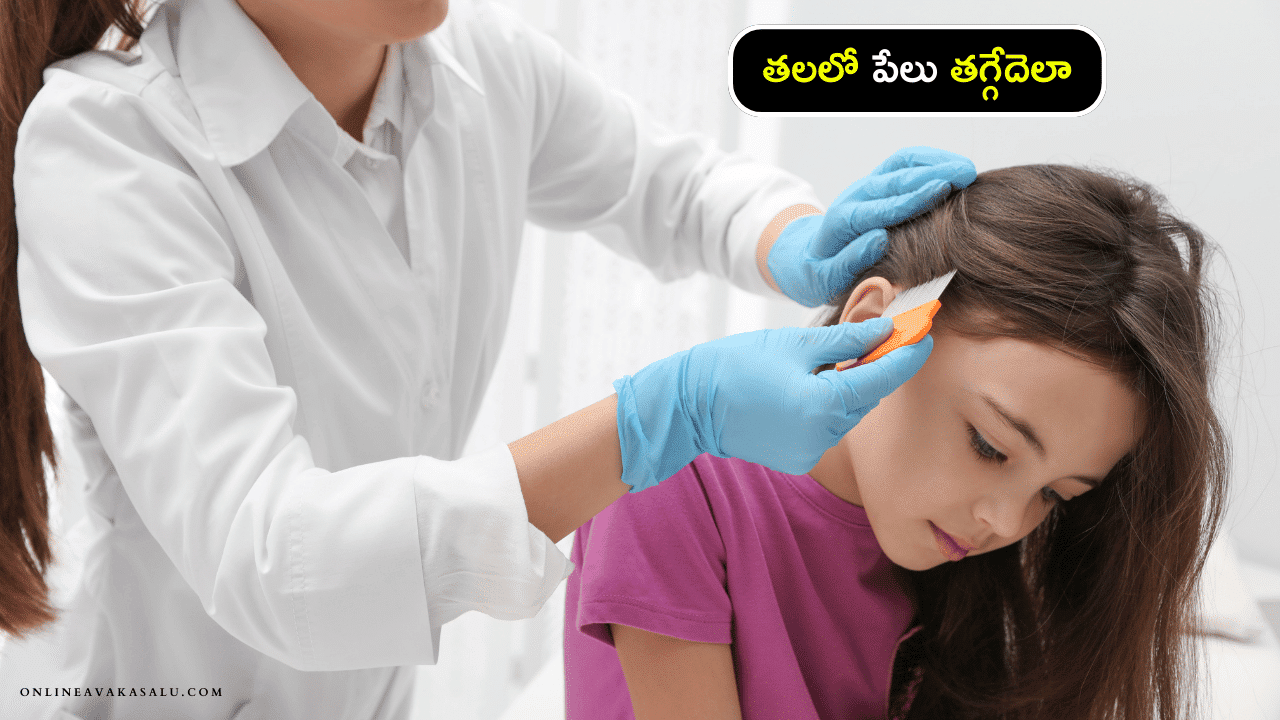 Reduce Head Lice : తలలో పేలు తగ్గేదెలా