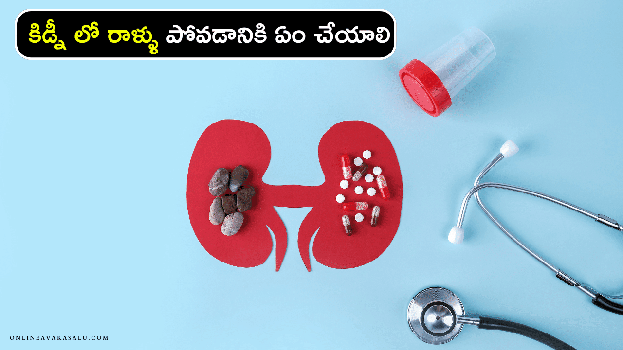 Kidney Stones : కిడ్నీ లో రాళ్ళు పోవడానికి ఏం చేయాలి