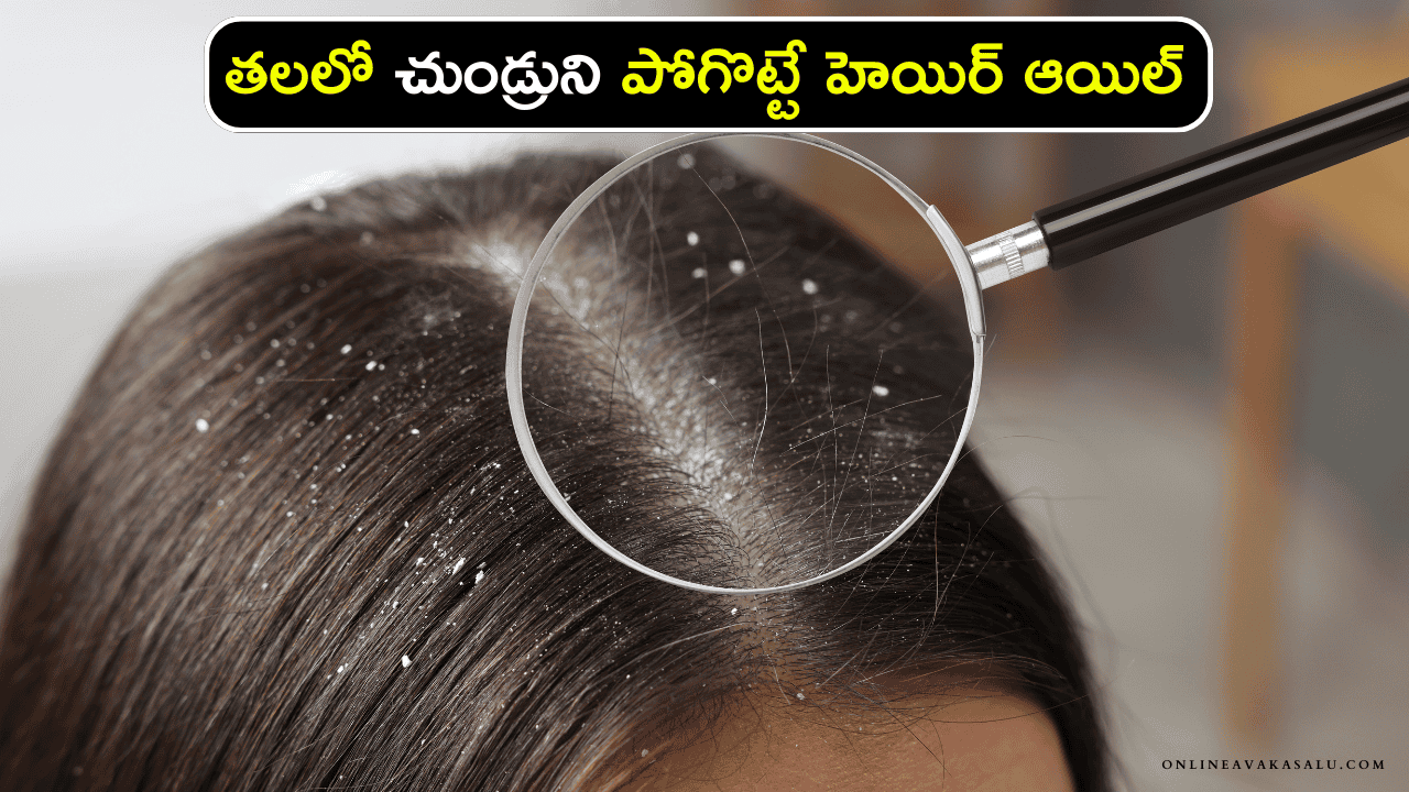 Dandruff Treatment తలలో చుండ్రుని పోగొట్టే హెయిర్ ఆయిల్